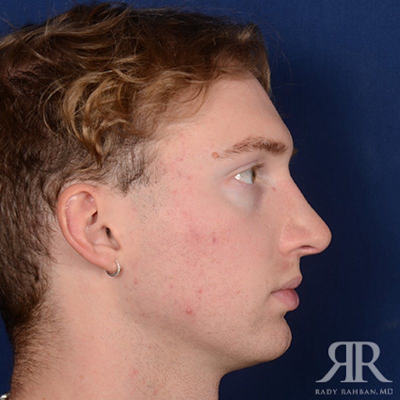 Male Rhinoplasty Before & After Gallery - Patient 149522 - Image 6