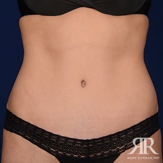 Tummy Tuck Before & After Gallery - Patient 112590 - Image 2