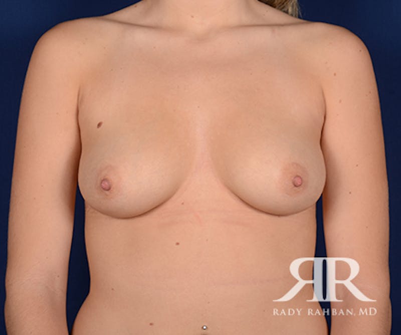 Breast Augmentation Before & After Gallery - Patient 203318 - Image 1