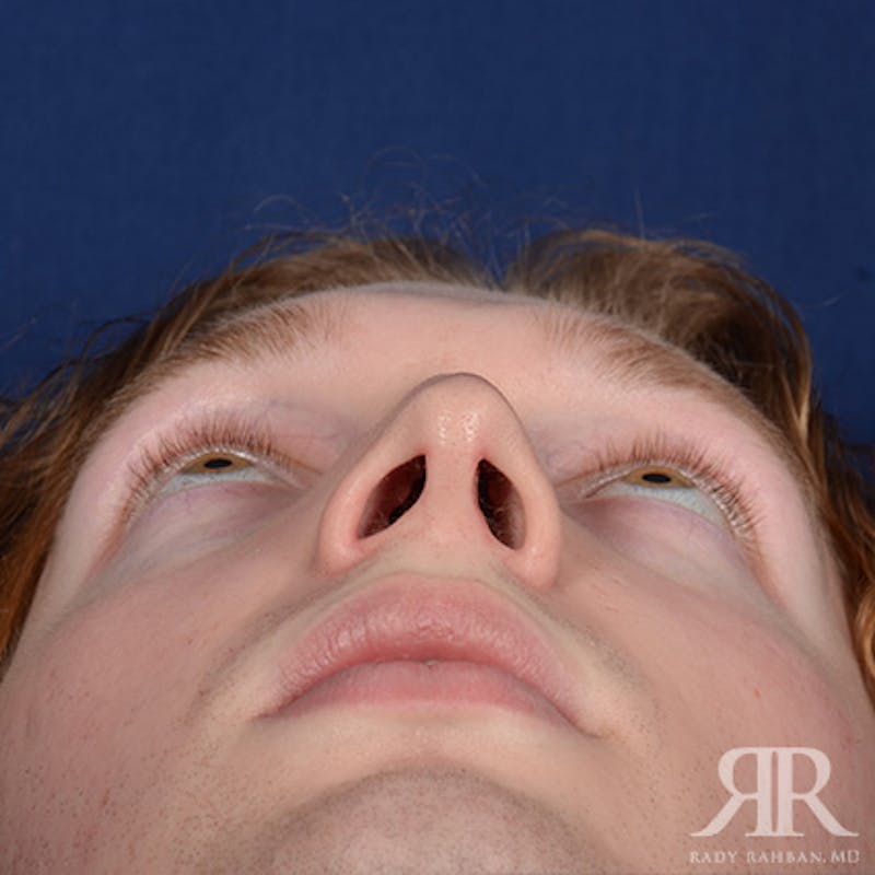 Male Rhinoplasty Before & After Gallery - Patient 149522 - Image 7
