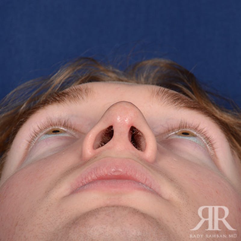 Male Rhinoplasty Before & After Gallery - Patient 149522 - Image 8