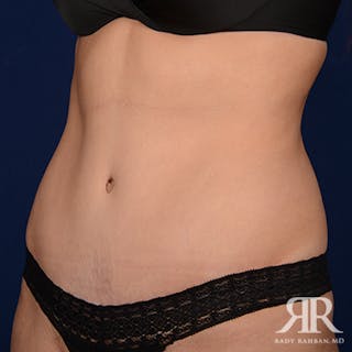 Tummy Tuck Before & After Gallery - Patient 112590 - Image 4