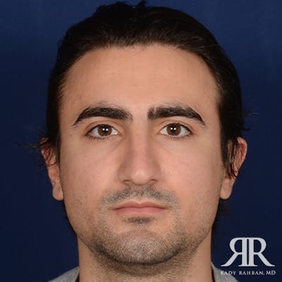Male Rhinoplasty Before & After Gallery - Patient 395593 - Image 1