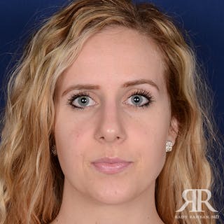 Female Rhinoplasty Before & After Gallery - Patient 483495 - Image 2