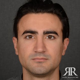 Male Rhinoplasty Before & After Gallery - Patient 395593 - Image 2