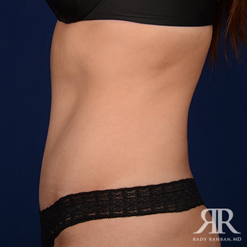 Tummy Tuck Before & After Gallery - Patient 112590 - Image 6