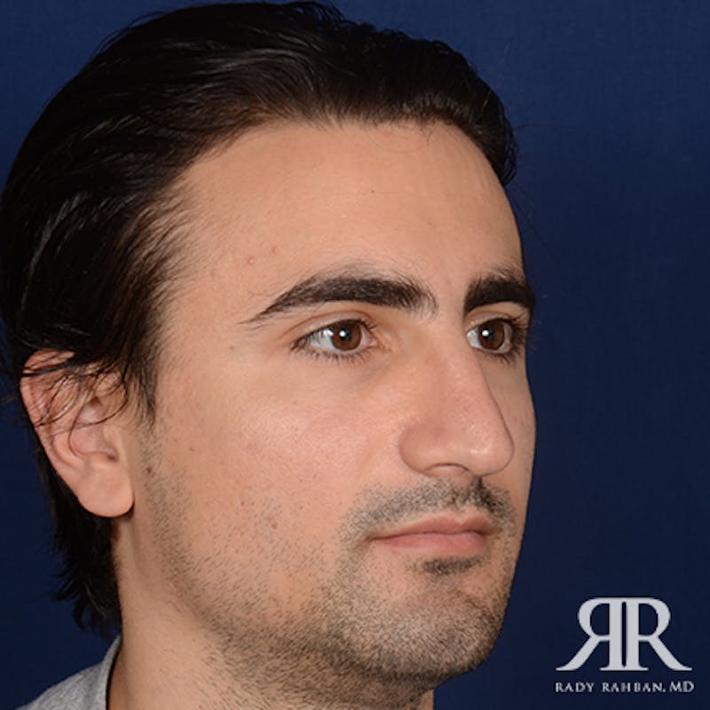 Male Rhinoplasty Before & After Gallery - Patient 395593 - Image 3