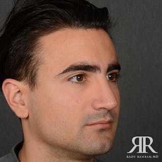 Male Rhinoplasty Before & After Gallery - Patient 395593 - Image 4