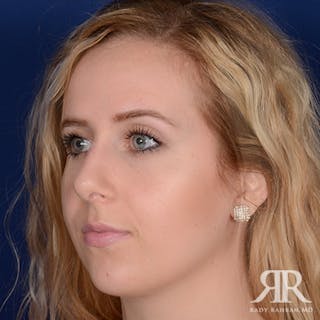 Female Rhinoplasty Before & After Gallery - Patient 483495 - Image 4