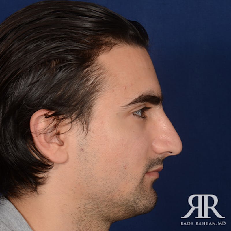 Male Rhinoplasty Before & After Gallery - Patient 395593 - Image 5