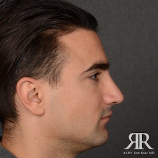Male Rhinoplasty Before & After Gallery - Patient 395593 - Image 6