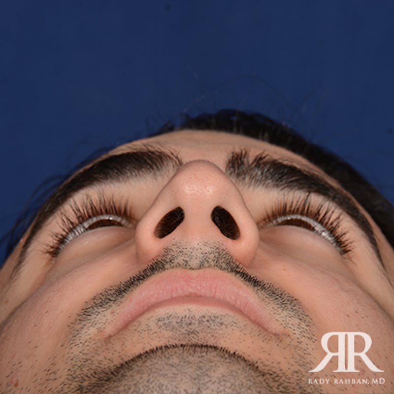 Male Rhinoplasty Before & After Gallery - Patient 395593 - Image 7