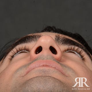 Male Rhinoplasty Before & After Gallery - Patient 395593 - Image 8