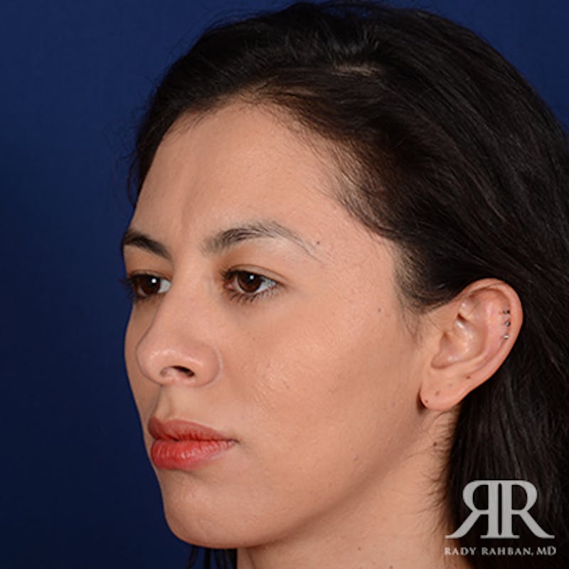 Female Rhinoplasty Before & After Gallery - Patient 231637 - Image 3