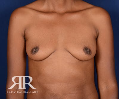Breast Augmentation Before & After Gallery - Patient 229502 - Image 1