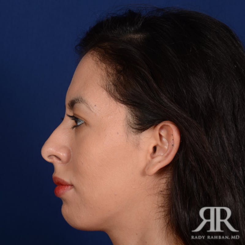 Female Rhinoplasty Before & After Gallery - Patient 231637 - Image 5