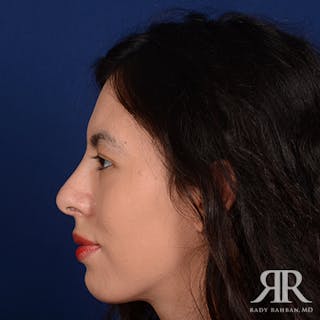 Female Rhinoplasty Before & After Gallery - Patient 231637 - Image 6