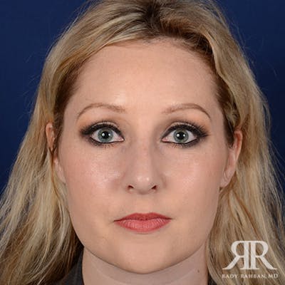 Female Rhinoplasty Before & After Gallery - Patient 489548 - Image 2