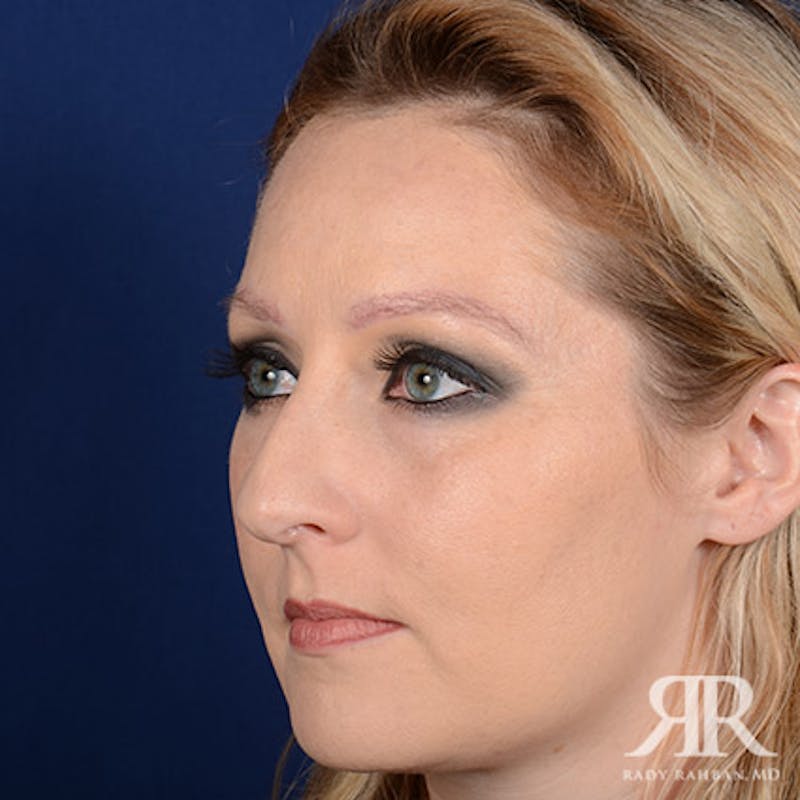 Female Rhinoplasty Before & After Gallery - Patient 489548 - Image 3