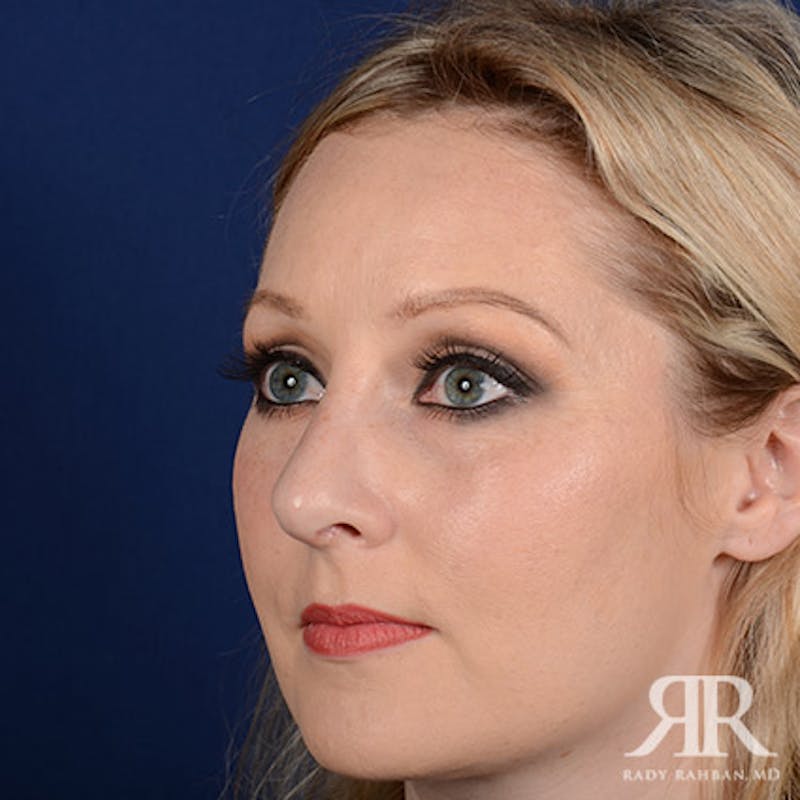 Female Rhinoplasty Before & After Gallery - Patient 489548 - Image 4