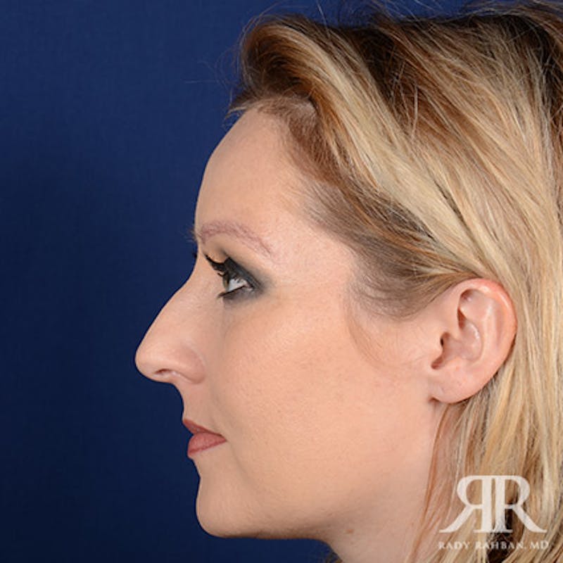 Female Rhinoplasty Before & After Gallery - Patient 489548 - Image 5