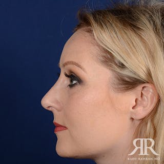 Female Rhinoplasty Before & After Gallery - Patient 489548 - Image 6
