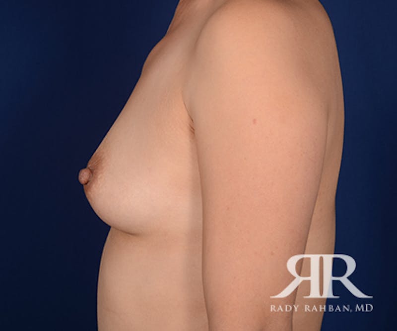 Breast Augmentation Before & After Gallery - Patient 315482 - Image 5