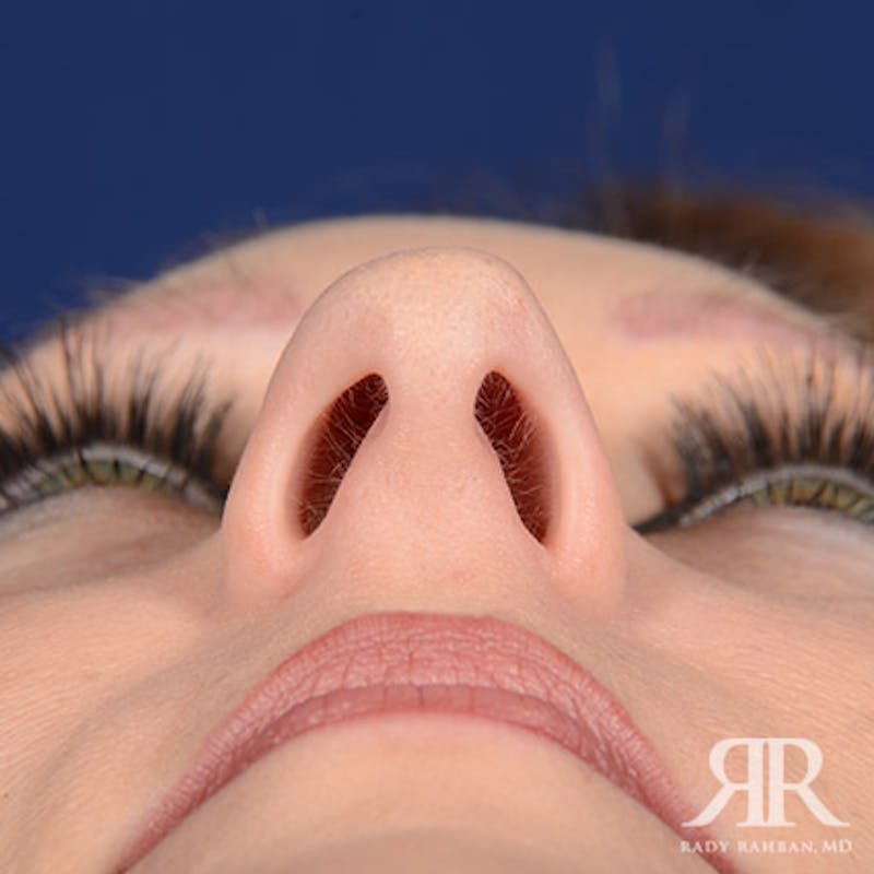 Female Rhinoplasty Before & After Gallery - Patient 489548 - Image 7