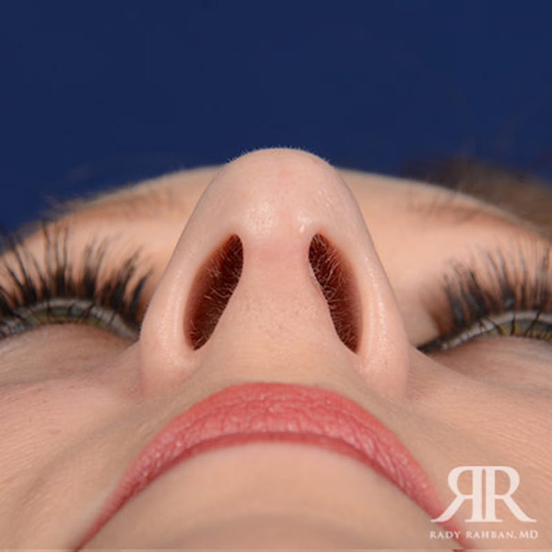 Female Rhinoplasty Before & After Gallery - Patient 489548 - Image 8