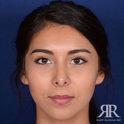 Female Rhinoplasty Before & After Gallery - Patient 329053 - Image 2