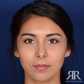 Female Rhinoplasty Before & After Gallery - Patient 329053 - Image 2