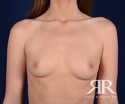 Breast Augmentation Before & After Gallery - Patient 963894 - Image 1