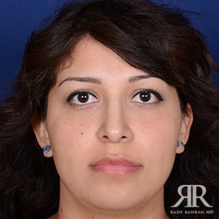 Female Rhinoplasty Before & After Gallery - Patient 214317 - Image 2