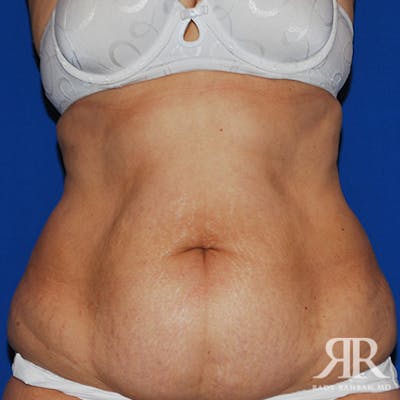 Tummy Tuck Before & After Gallery - Patient 173174 - Image 1
