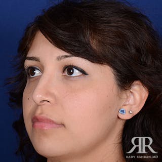 Female Rhinoplasty Before & After Gallery - Patient 214317 - Image 4