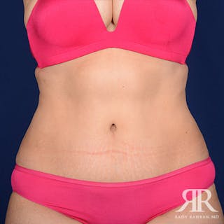 Tummy Tuck Before & After Gallery - Patient 173174 - Image 2