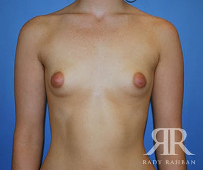 Breast Augmentation Before & After Gallery - Patient 145496 - Image 1