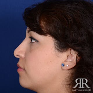Female Rhinoplasty Before & After Gallery - Patient 214317 - Image 6