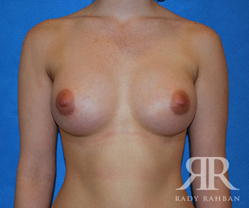 Breast Augmentation Before & After Gallery - Patient 145496 - Image 2