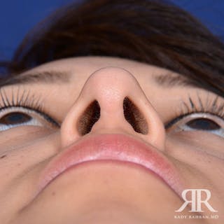 Female Rhinoplasty Before & After Gallery - Patient 214317 - Image 8