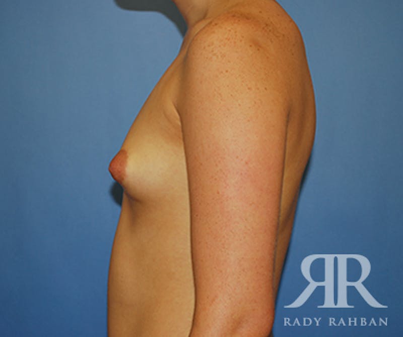 Breast Augmentation Before & After Gallery - Patient 145496 - Image 5