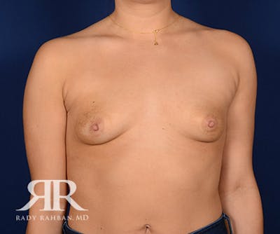 Breast Augmentation Before & After Gallery - Patient 110391 - Image 1