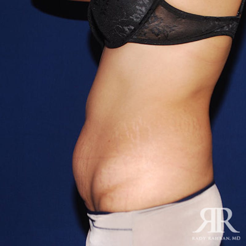 Tummy Tuck Before & After Gallery - Patient 134991 - Image 5