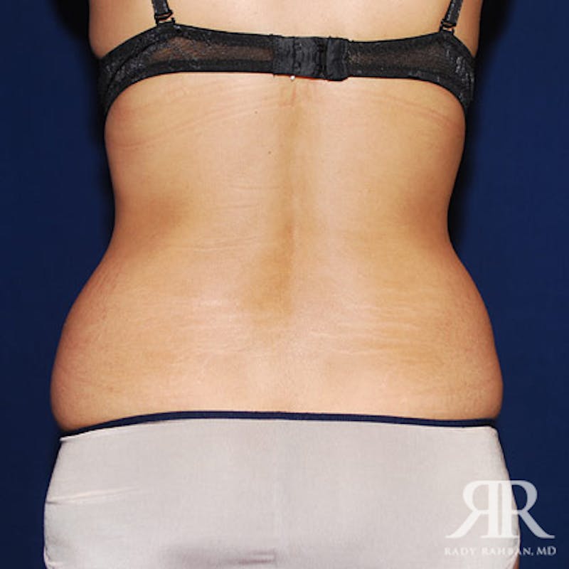 Tummy Tuck Before & After Gallery - Patient 134991 - Image 7