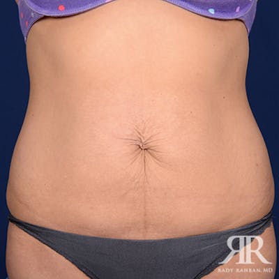 Tummy Tuck Before & After Gallery - Patient 364064 - Image 1