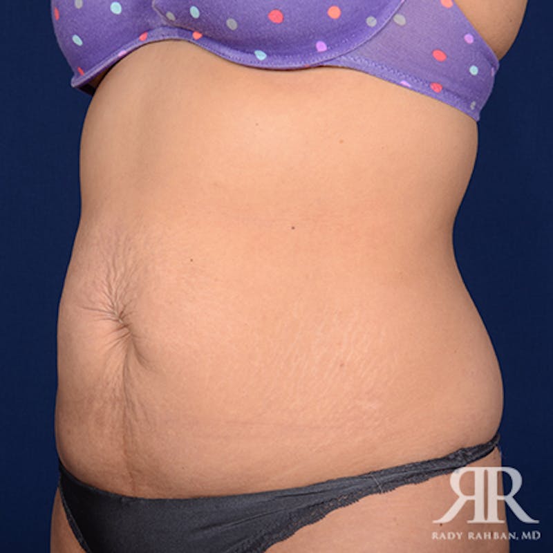 Tummy Tuck Before & After Gallery - Patient 364064 - Image 3