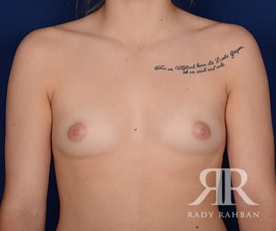 Breast Augmentation Before & After Gallery - Patient 986409 - Image 1