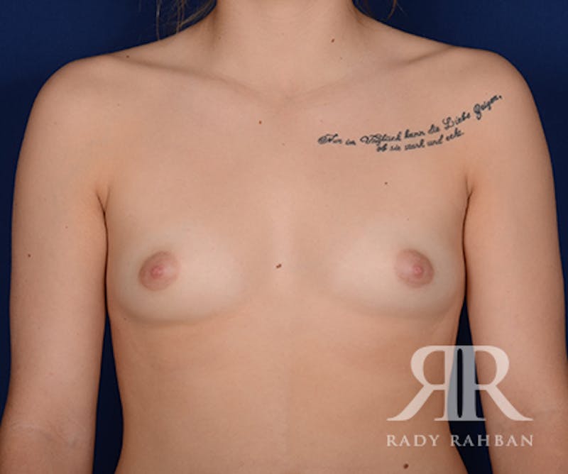 Breast Augmentation Before & After Gallery - Patient 986409 - Image 1