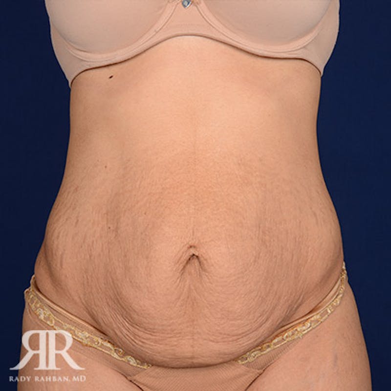 Tummy Tuck Before & After Gallery - Patient 257925 - Image 1