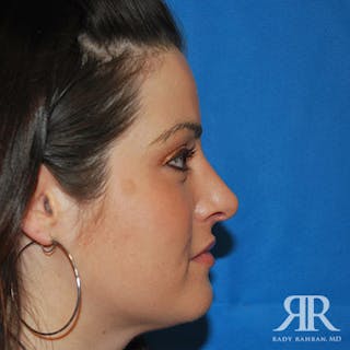 Female Rhinoplasty Before & After Gallery - Patient 323085 - Image 2